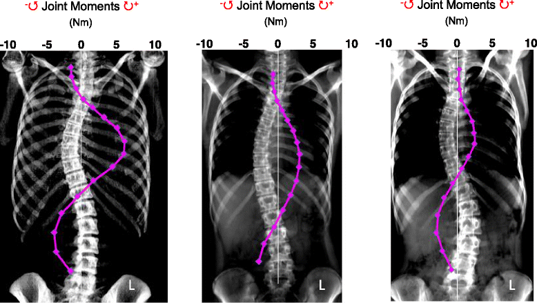 Gravity-induced coronal plane joint moments in adolescent idiopathic  scoliosis | Scoliosis and Spinal Disorders | Full Text