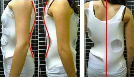 Brace technology thematic series: the 3D Rigo Chêneau-type brace | Scoliosis and Spinal Disorders | Full Text