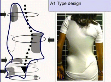 Brace technology thematic series: the 3D Rigo Chêneau-type brace | Scoliosis and Spinal Disorders | Full Text