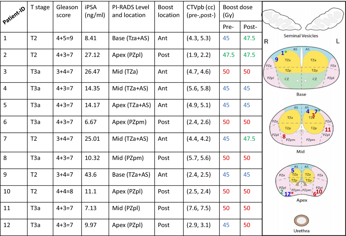 Simultaneous integrated boost (SIB) to dominant intra-prostatic lesions  during extreme hypofractionation for prostate cancer: the impact of rectal  spacers | Radiation Oncology | Full Text