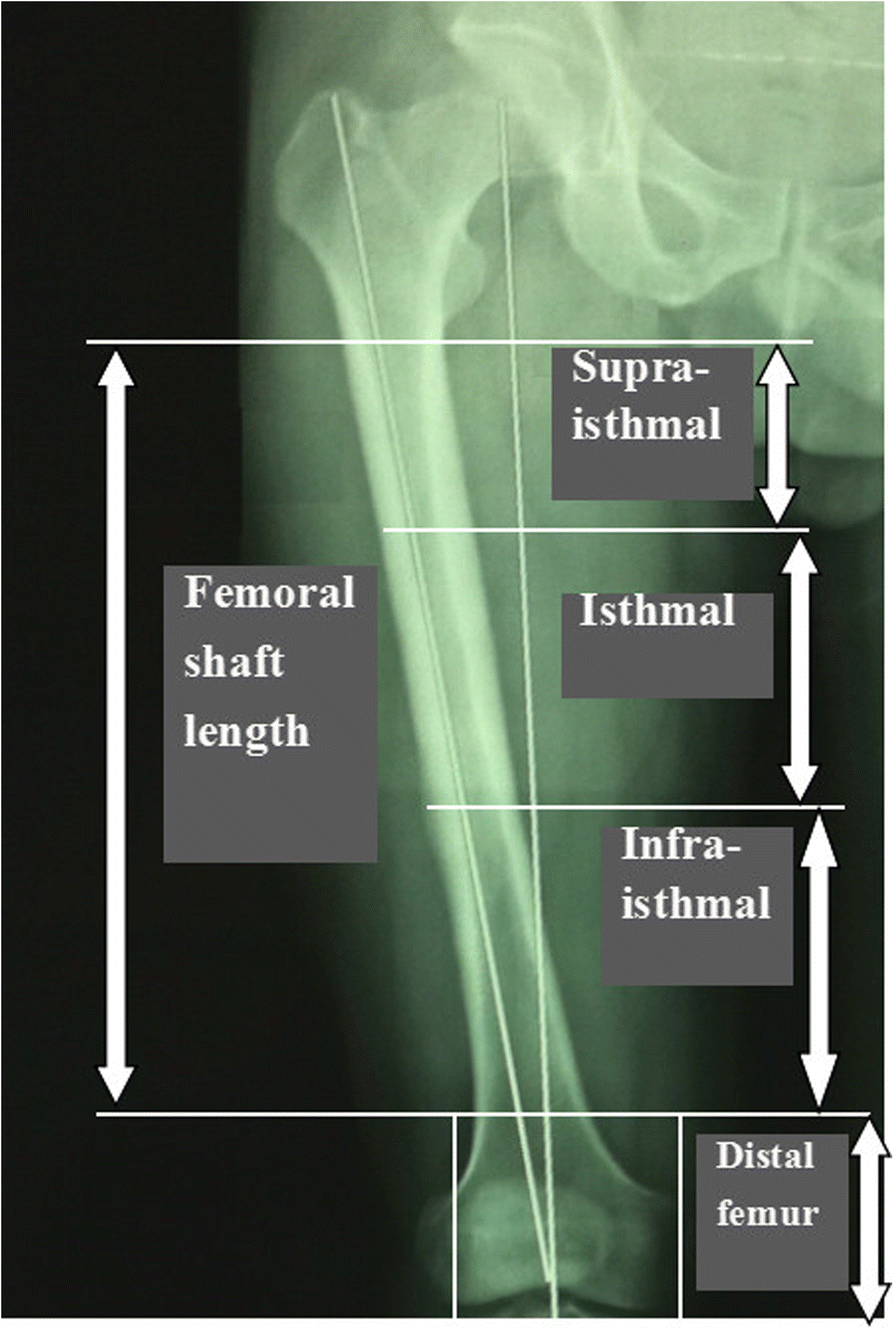 Retrograde traditional femoral or tibial locked intramedullary nails for  distal femoral injuries - ScienceDirect
