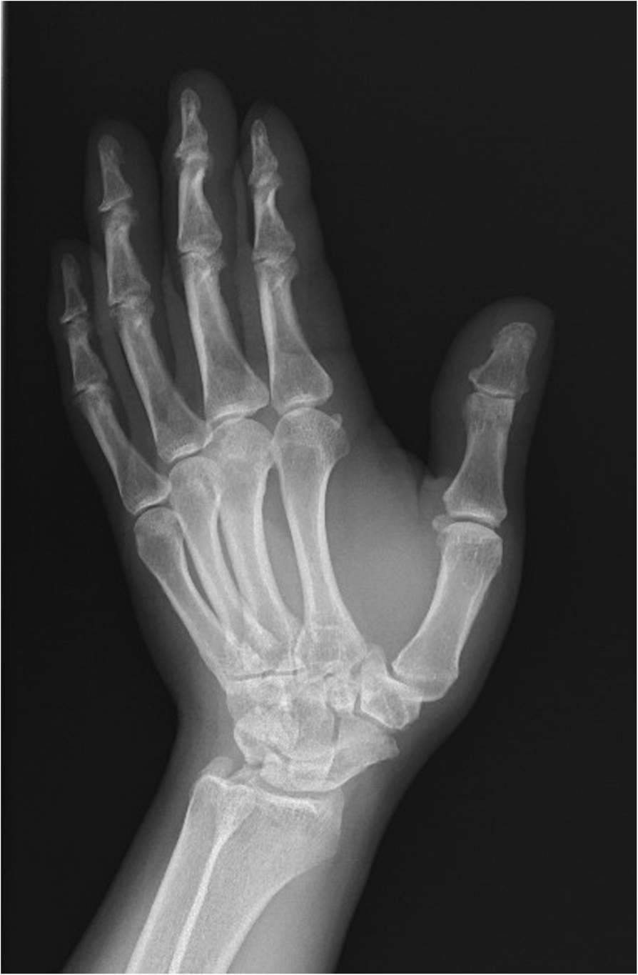 Comparison of arthrodesis and arthroplasty of Chinese thumb carpometacarpal  osteoarthritis | Journal of Orthopaedic Surgery and Research | Springer  Nature Link