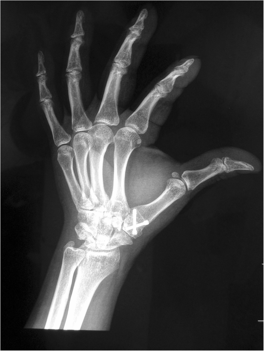Comparison of arthrodesis and arthroplasty of Chinese thumb carpometacarpal  osteoarthritis | Journal of Orthopaedic Surgery and Research | Springer  Nature Link