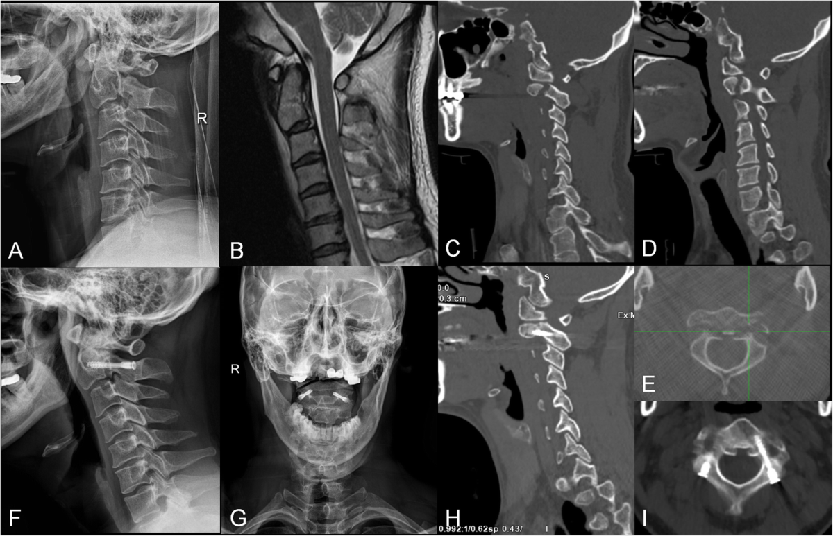 Typically Unstable (Subsection 3B) - Clinical Imaging of Spinal Trauma, image size:1200x773