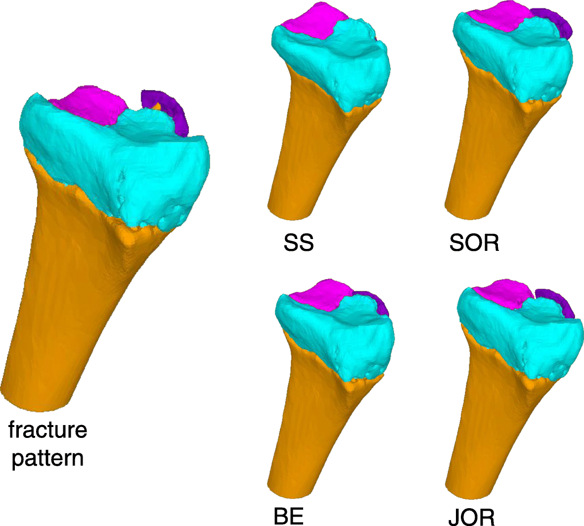 Inter-rater variability of three-dimensional fracture reduction planning  according to the educational background | Journal of Orthopaedic Surgery  and Research, image size:1181x1063