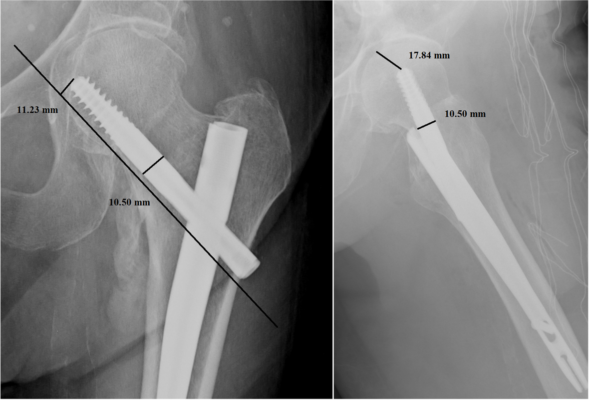 Zimmer Natural Nail and ELOS nails in pertrochanteric fractures | Journal  of Orthopaedic Surgery and Research | Springer Nature Link