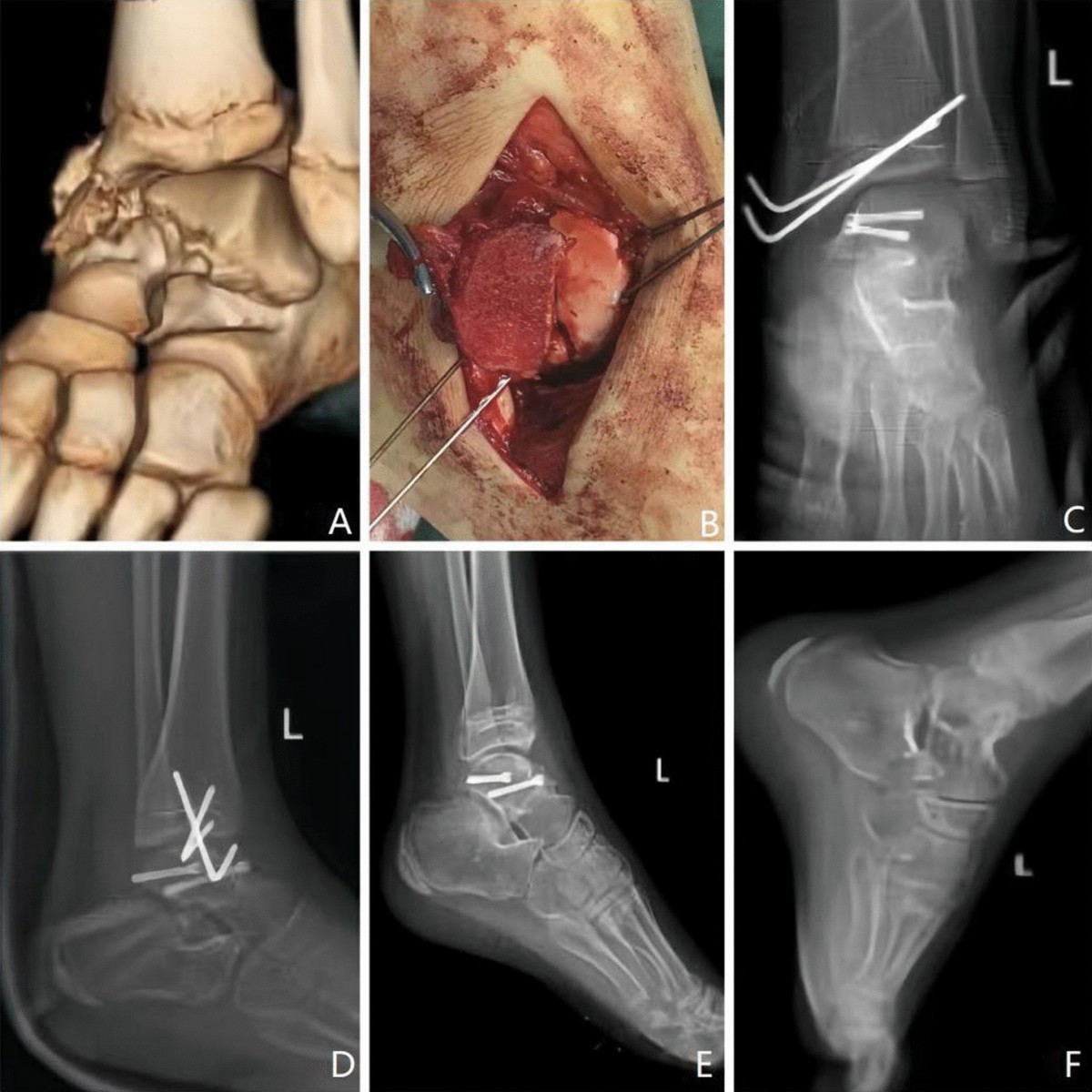 Anteromedial cannulated screw fixation for Hawkins II/III talus fractures  in children: a retrospective study | Journal of Orthopaedic Surgery and  Research | Springer Nature Link