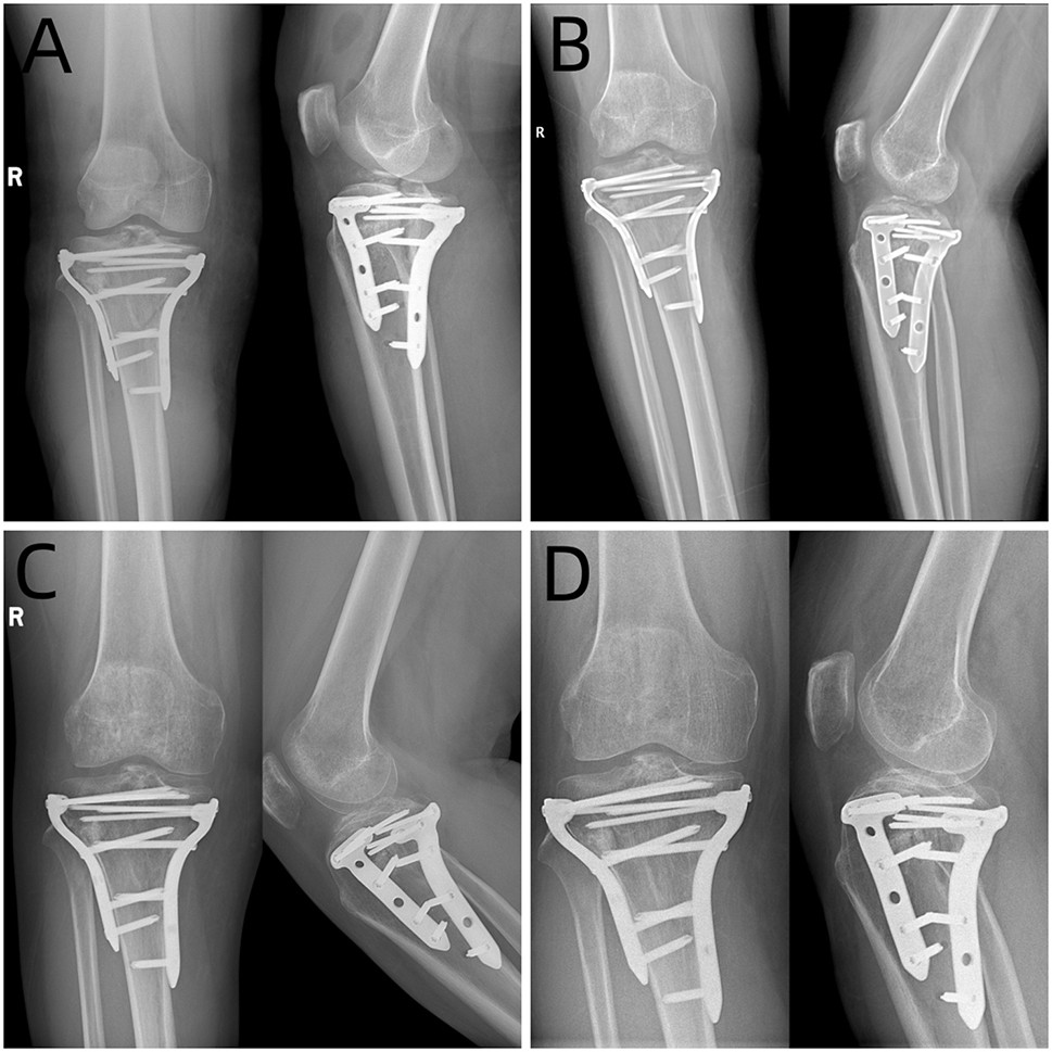 High validity of measuring the width and volume of medial meniscal  extrusion three-dimensionally using an MRI-derived tibial model | Journal  of Experimental Orthopaedics, image size:969x969