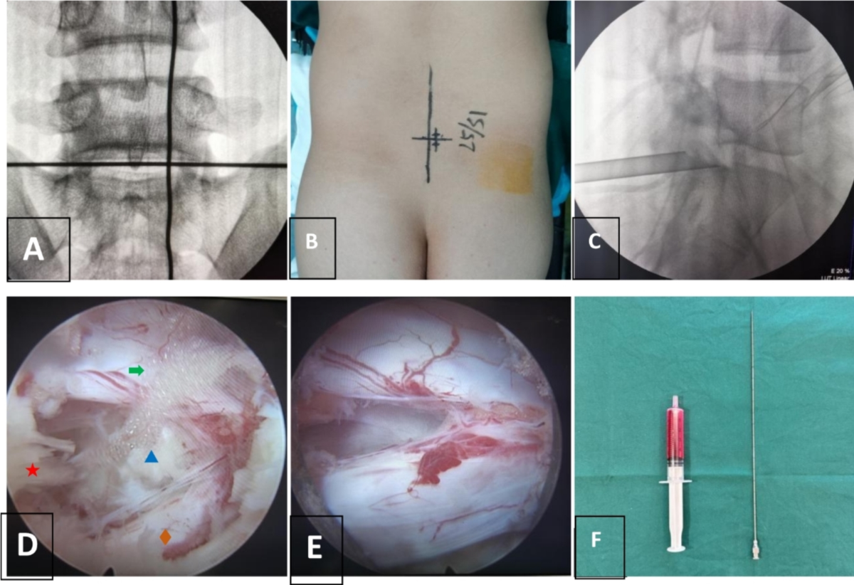 dexamethasone b12 injection Effects of dexamethasone combined with vitamin B12 on percutaneous  endoscopic interlaminar discectomy early outcomes: a randomized controlled  trial | Journal of Orthopaedic Surgery and Research
