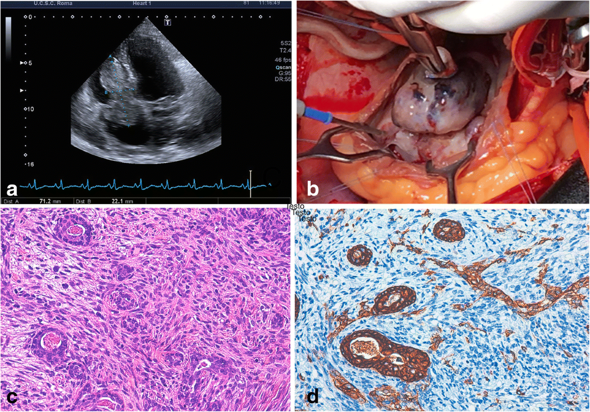 melanotic sarcoma of heart Childhood Tumors (PDQ) - PDQ Cancer Information Summaries Treatment of cardiac synovial sarcoma: