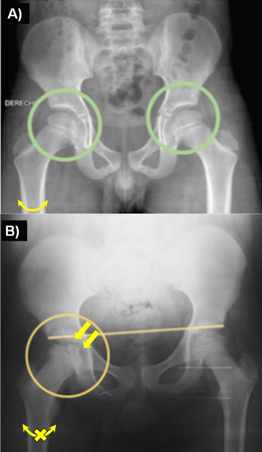 Legg–Calvé–Perthes disease overview | Orphanet Journal of Rare Diseases, image size:896x1546