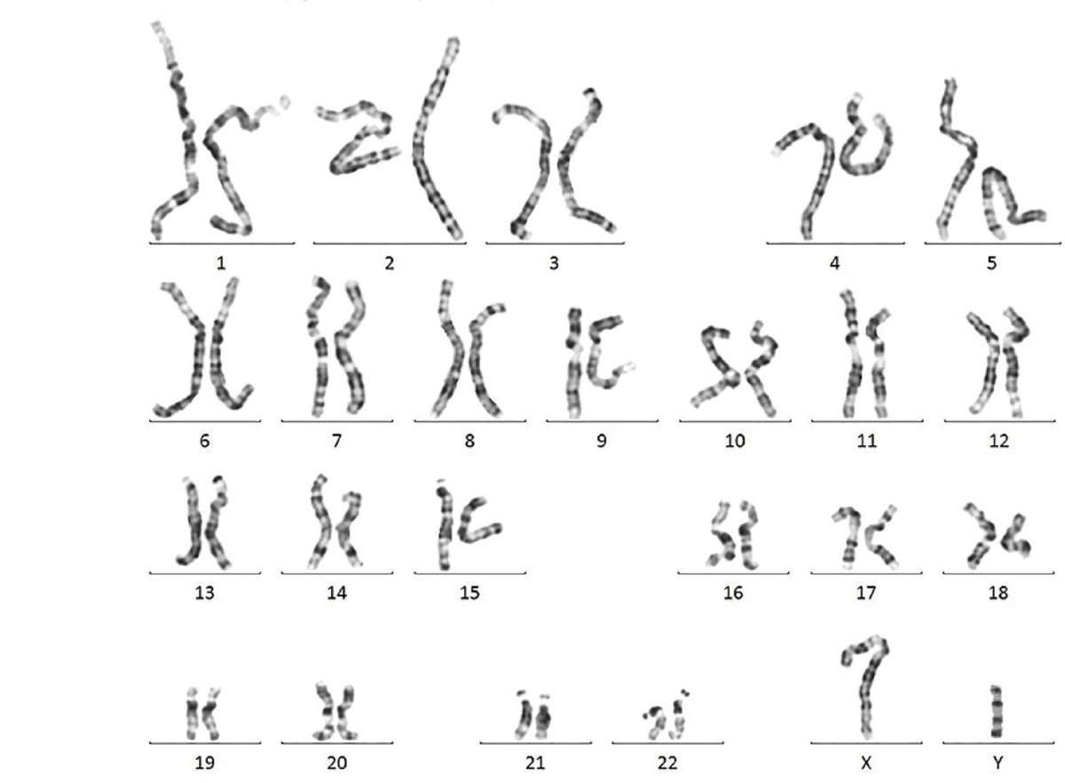 Isodicentric Y chromosome with SRY duplication in a female with complete  gonadal dysgenesis | Molecular Cytogenetics | Full Text, image size:1200x883