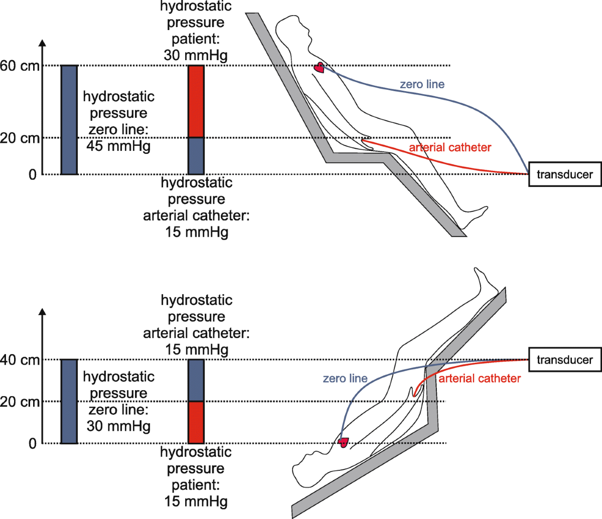 How to measure blood pressure using an arterial catheter: a systematic  5-step approach | Critical Care | Springer Nature Link