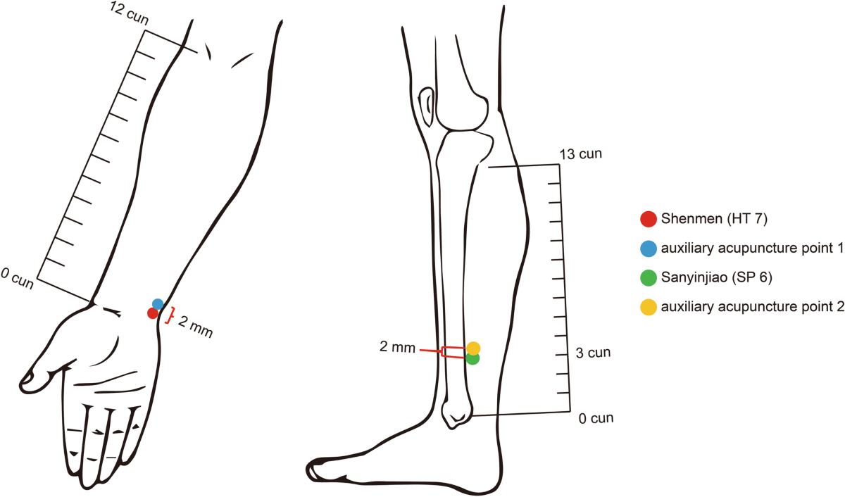 Acupoint combination effect of Shenmen (HT 7) and Sanyinjiao (SP 6) in  treating insomnia: study protocol for a randomized controlled trial | Trials