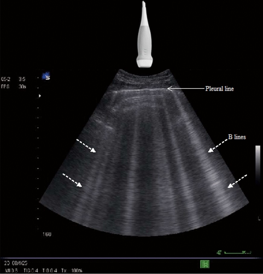 Bedside lung ultrasonography by emergency department residents as an aid for identifying heart failure in patients with acute dyspnea after a 2-h training course | The Ultrasound Journal | Full Text
