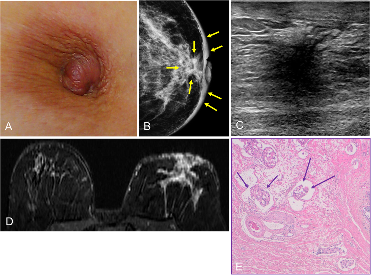 Multimodality approach to the nipple-areolar complex: a pictorial review  and diagnostic algorithm | Insights into Imaging | Full Text