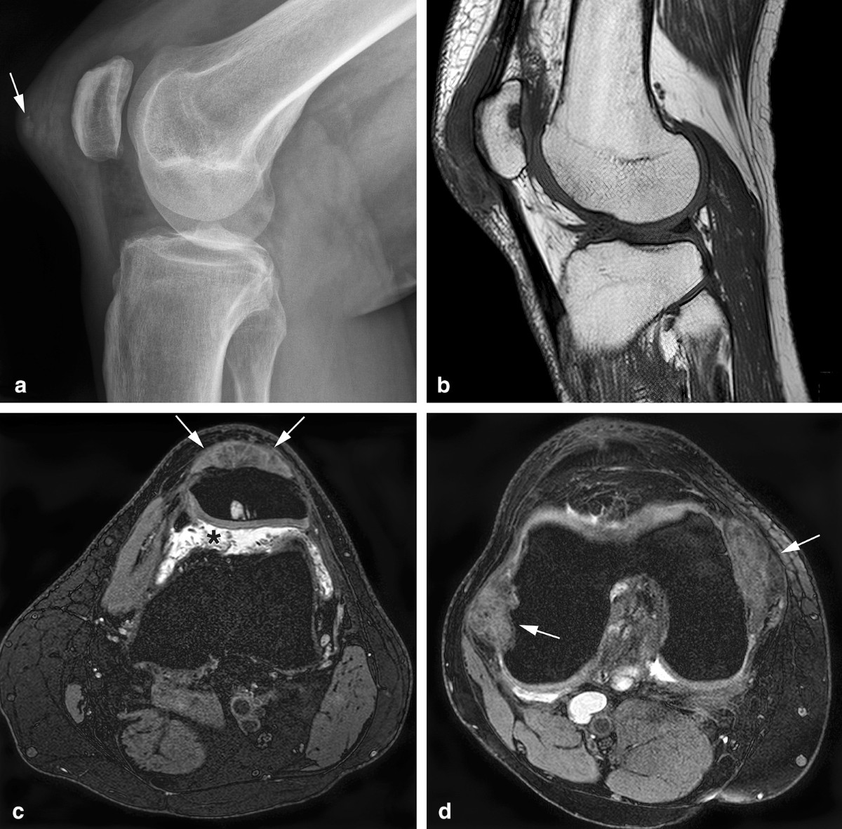 MRI of diffuse-type tenosynovial giant cell tumour in the knee: a guide for  diagnosis and treatment response assessment | Insights into Imaging, image size:1200x1182