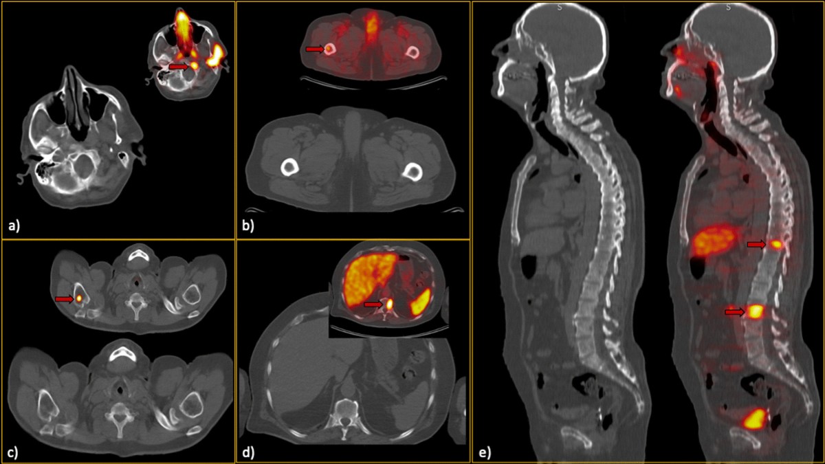 Whole-body low-dose CT can be of value in prostate cancer decision-making:  a retrospective study on 601 patients | Insights into Imaging, image size:1200x675
