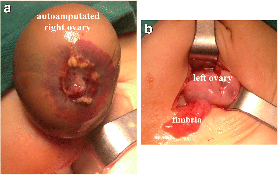 A Case of Torsion in an Otherwise-Normal Ovary in a 22-years old  nulliparous women: Utilization of Diagnostic Laparoscopy, image size:1181x744