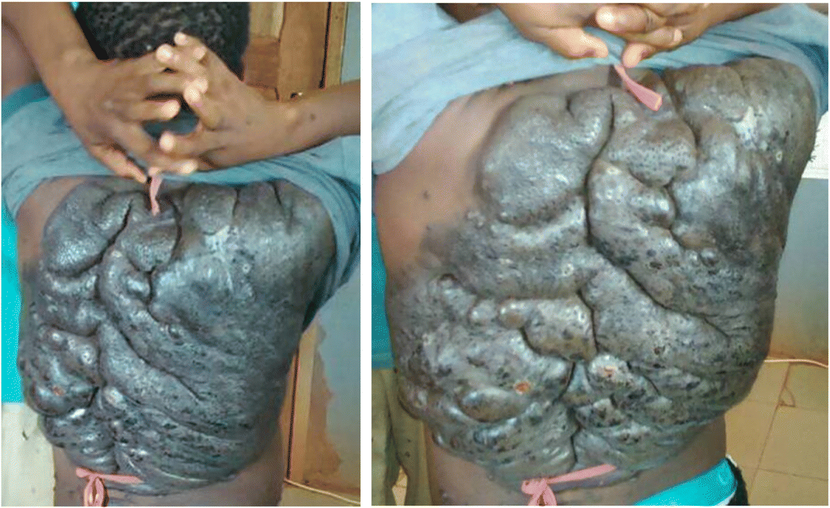 melanotic nevus Melanocytic Nevi (Moles) | Fact Sheets main image 0