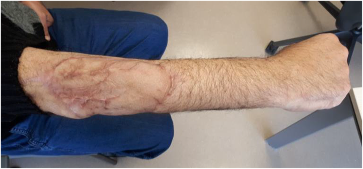 Fungating malignant peripheral nerve sheath tumor arising from a  slow-growing mass in the forearm: a case report and review of the  literature | Journal of Medical Case Reports