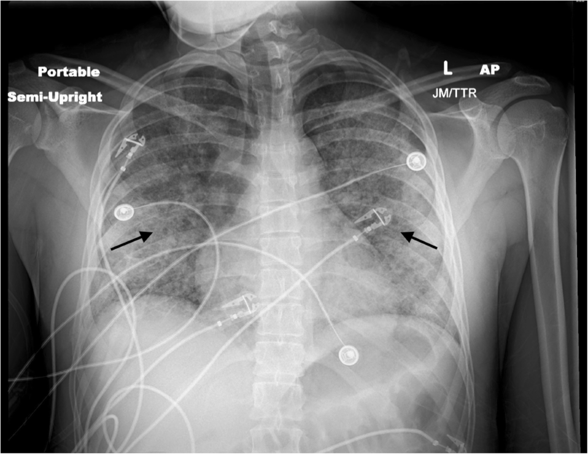 A 23-year-old man with acute lung injury after using a  tetrahydrocannabinol-containing vaping device: a case report | Journal of  Medical Case Reports