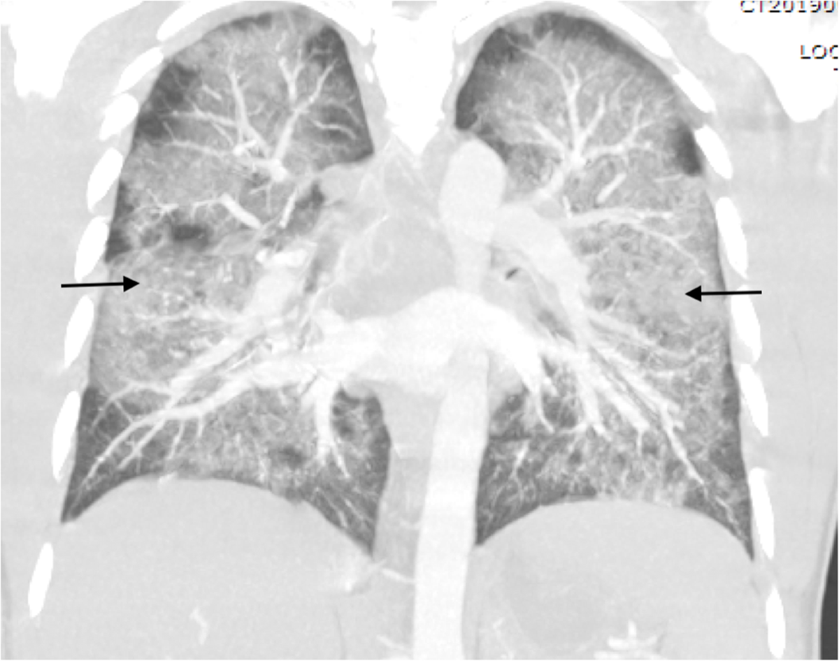 A 23-year-old man with acute lung injury after using a  tetrahydrocannabinol-containing vaping device: a case report | Journal of  Medical Case Reports