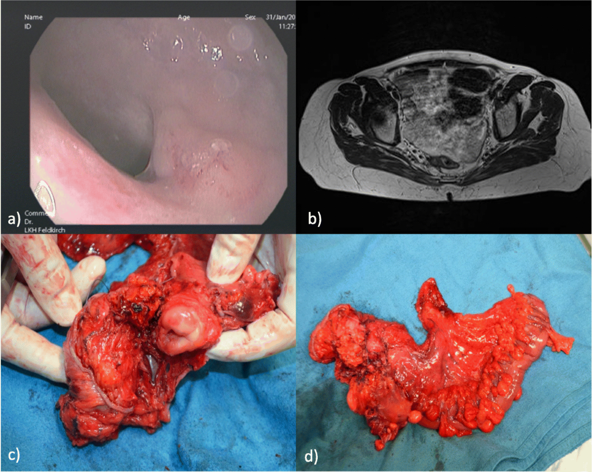 Diagnostically challenging human papillomavirus-associated primary squamous  cell carcinoma of the rectum with metastasis in both ovaries: a case report  | Journal of Medical Case Reports | Full Text