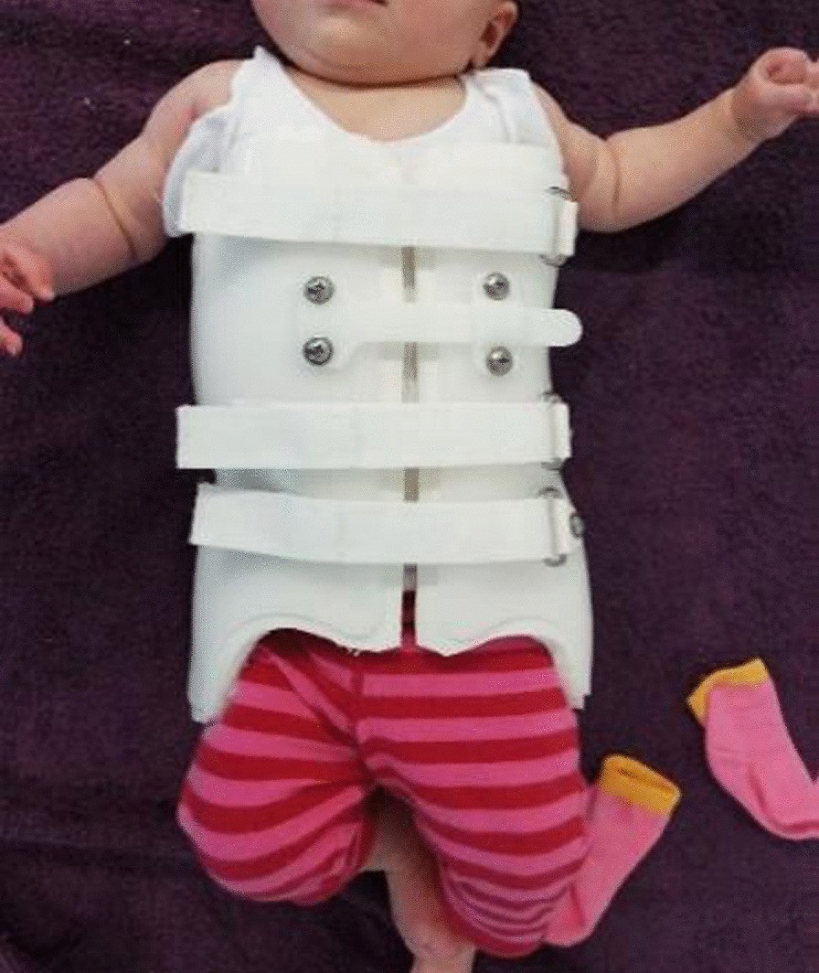 Treatment of infantile idiopathic scoliosis using a novel thoracolumbosacral orthosis: a case report | Journal of Medical Case Reports | Full Text