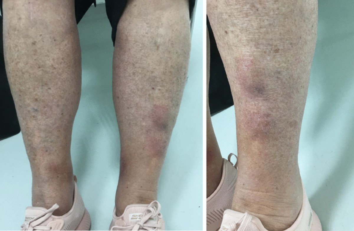 Painful lower limb nodules as first symptom of resectable pancreatic acinar cell cancer: a case report | Journal of Medical Case Reports | Springer Nature Link