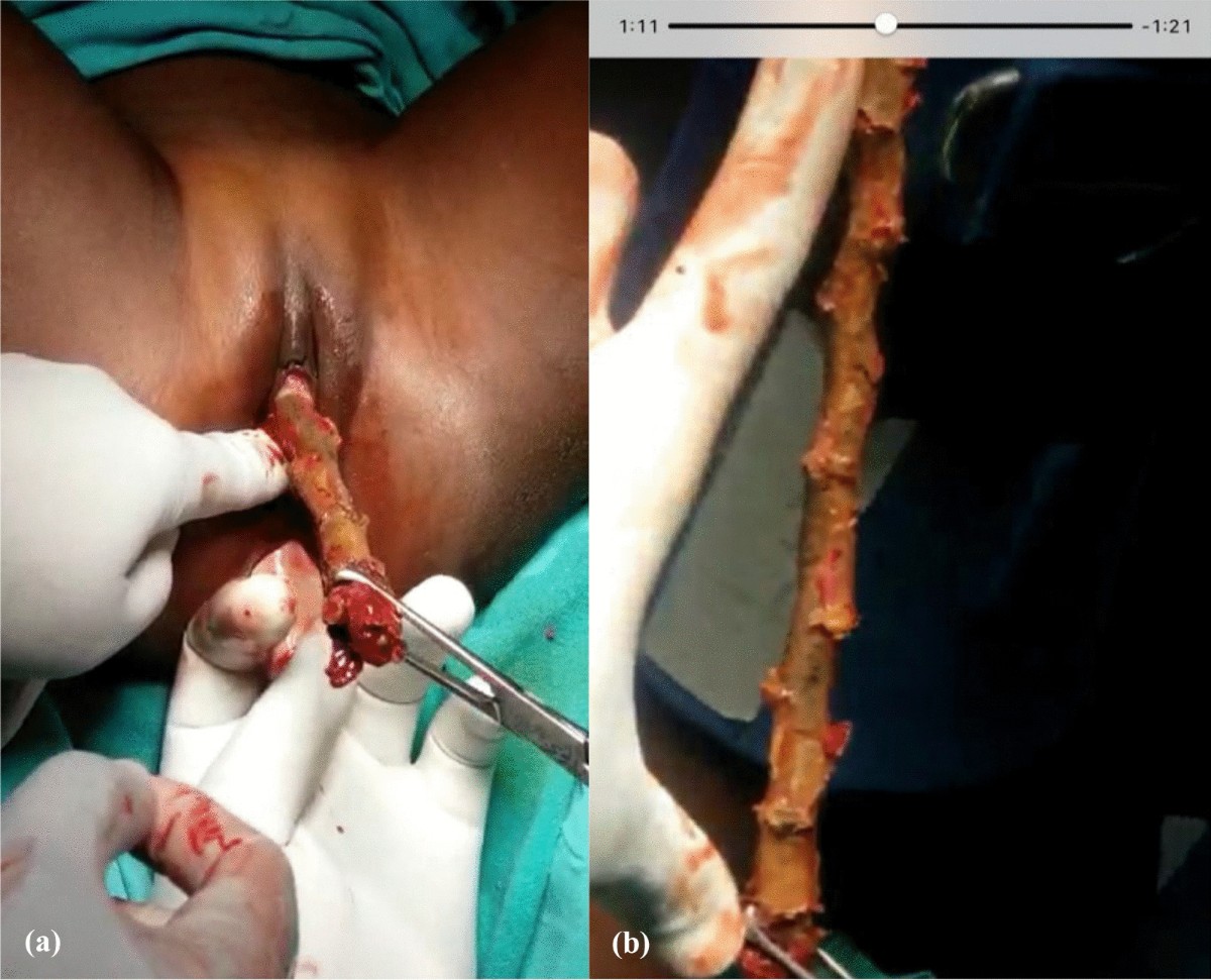 pediatric genital trauma 4. Longstanding Prepubertal Vaginal Bleeding in an 8 year old Secondary to  Genital Self-Mutilation - Journal of Pediatric and Adolescent Gynecology