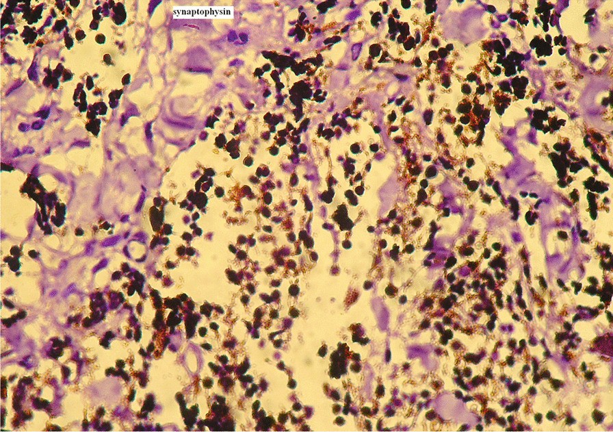 melanotic neuroectodermal tumor of infancy pathology Melanotic neuroectodermal tumor of infancy: a case report | Journal of  Medical Case Reports