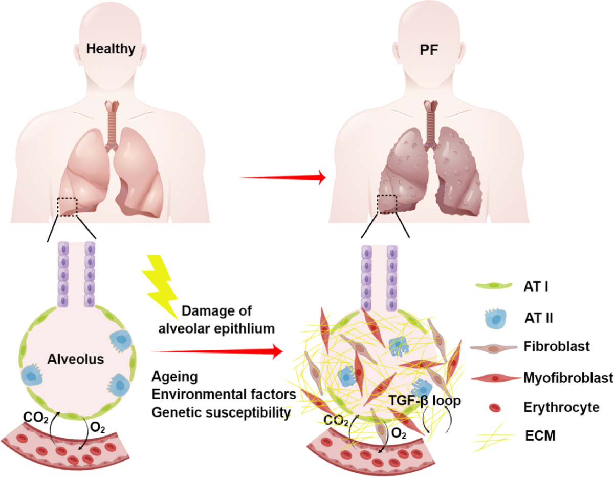 Stem cell-based therapy for pulmonary fibrosis | Stem Cell Research & Therapy | Full Text