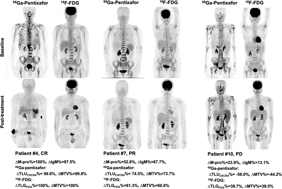 Semi-quantitative measurements of chemokine receptor 4-targeted  68Ga-pentixafor PET/CT in response assessment of Waldenström  macroglobulinemia/lymphoplasmacytic lymphoma | EJNMMI Research