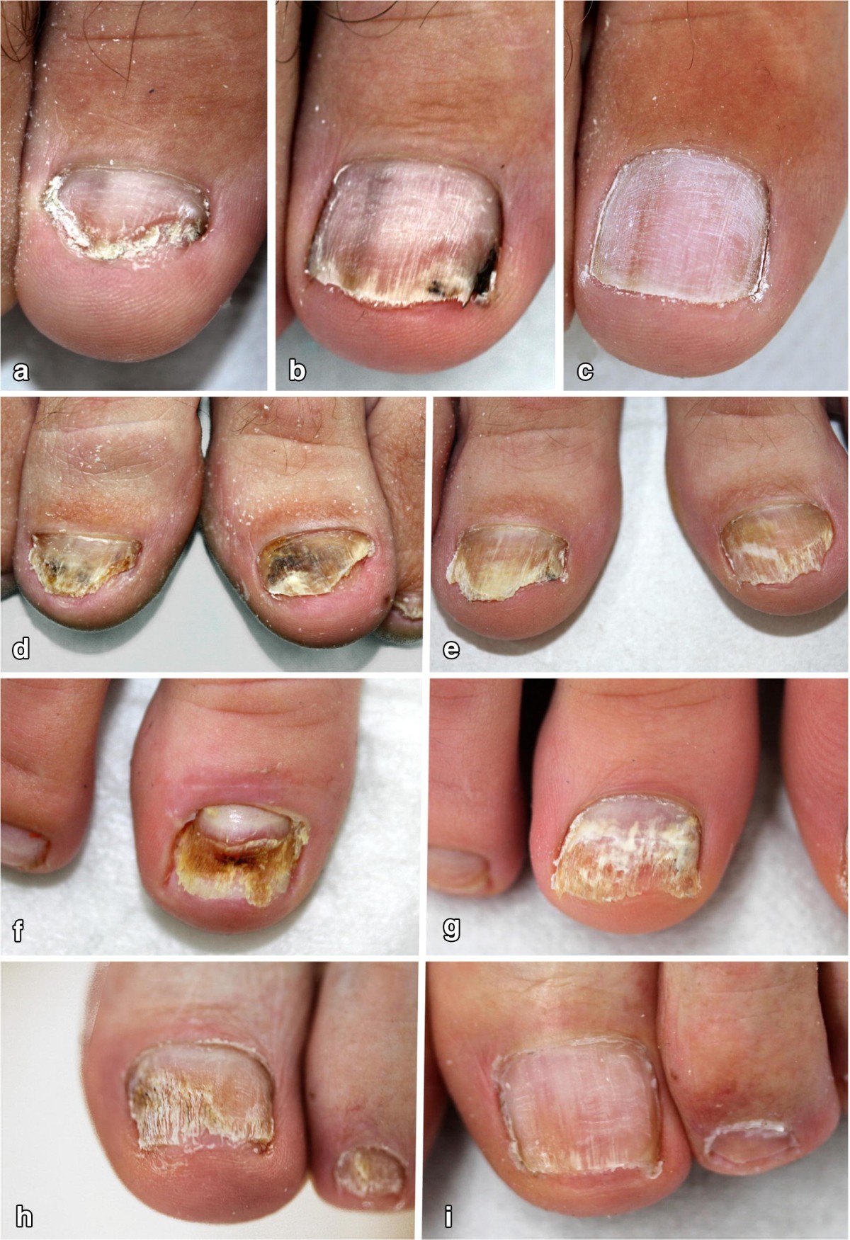 Treatment of onychomycosis using a 1064-nm diode laser with or 