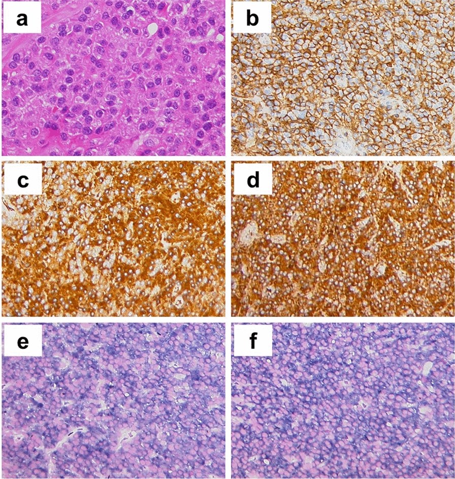 A case of solitary plasmacytoma of bone showing co-expression of both  immunoglobulin light chains | European Journal of Medical Research