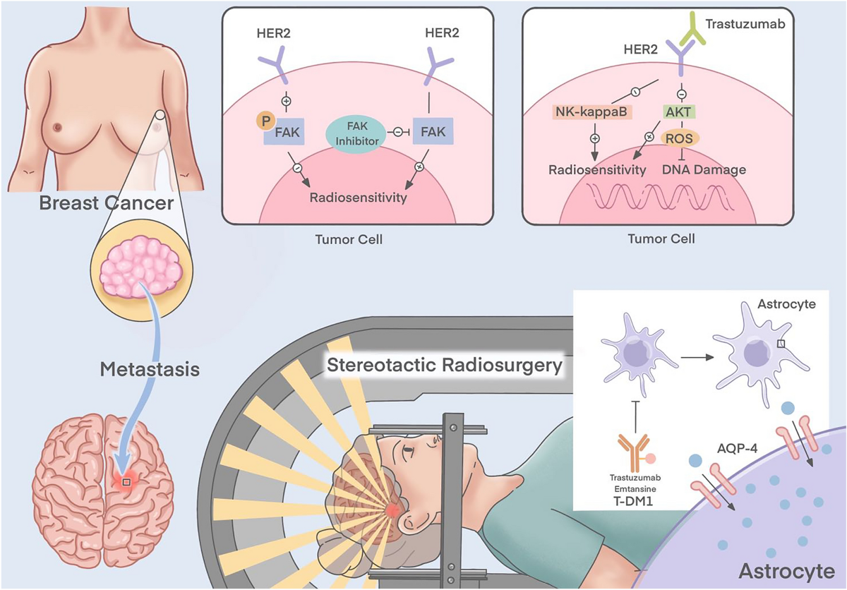 Combination of radiotherapy and targeted therapy for HER2-positive breast cancer brain metastases | European Journal of Medical Research | Full Text