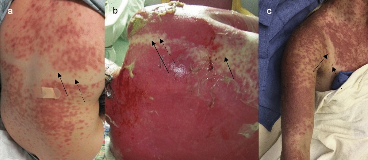 Photodistributed StevensJohnson syndrome and toxic epidermal necrolysis: a  systematic review and proposal for a new diagnostic classification |  European Journal of Medical Research | Springer Nature Link