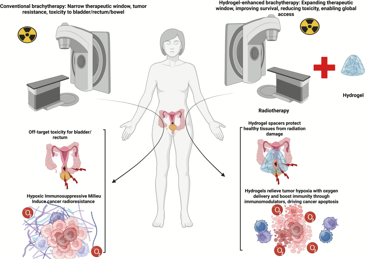 Hydrogel-enhanced brachytherapy in cervical cancer: redefining precision, efficacy, and safety | European Journal of Medical Research