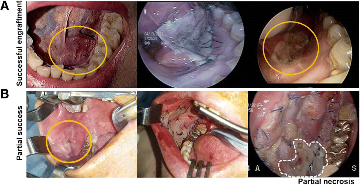 Modified bolster dressing with continuous suction improves skin graft  survival for an oral cavity wound | Journal of Otolaryngology - Head & Neck  Surgery | Springer Nature Link