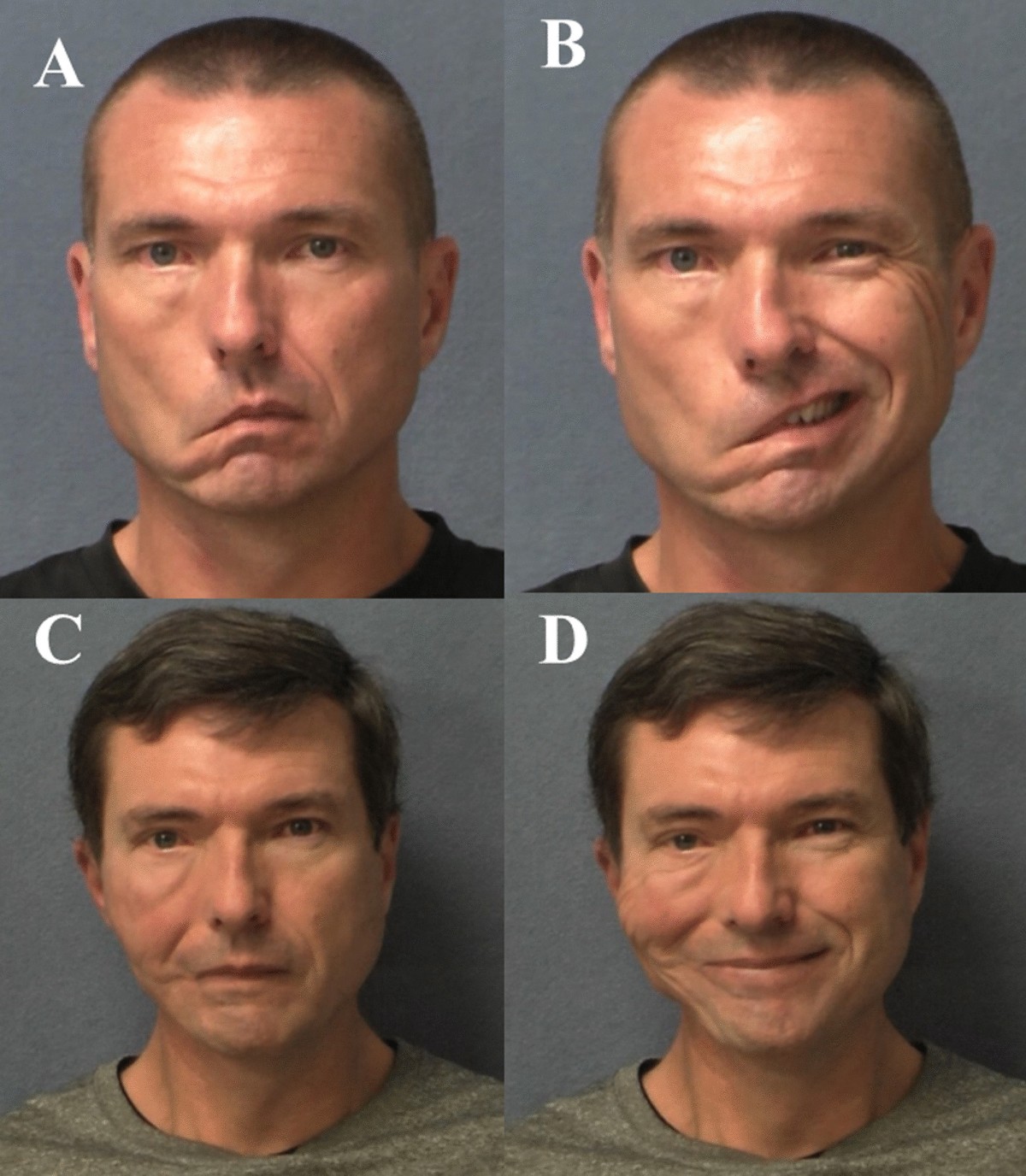 Bell's palsy misdiagnosis: characteristics of occult tumors causing facial  paralysis | Journal of Otolaryngology - Head \u0026 Neck Surgery, image size:1200x1376
