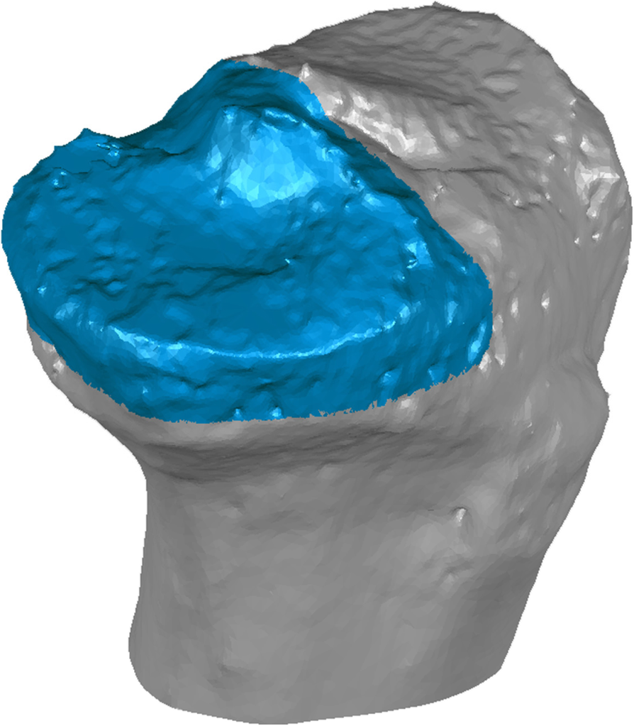 Adding Tibial Tuberosity Medialization to Medial Patellofemoral Ligament  Reconstruction Reduces Lateral Patellar Maltracking During Multidirectional  Motion in a Computational Simulation Model - Arthroscopy, Sports Medicine,  and Rehabilitation, image size:894x1023
