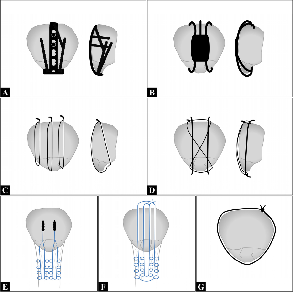 Surgical treatment of inferior pole fractures of the patella: a 