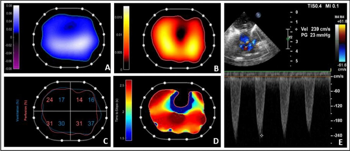 How Does Lung Perfusion Work in Ventilation Perfusion Coupling: Essential Insights