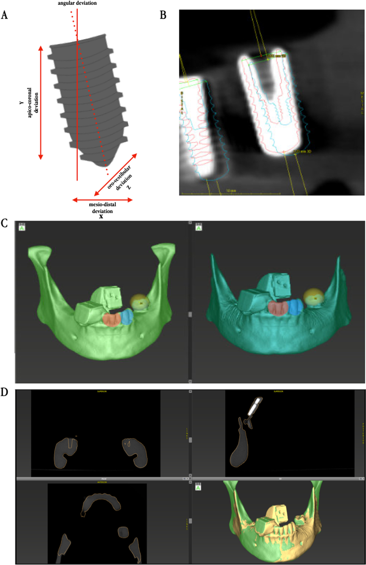 Accuracy of intraoral real-time navigation versus static,  CAD/CAM-manufactured pilot drilling guides in dental implant surgery: an in  vitro study | International Journal of Implant Dentistry