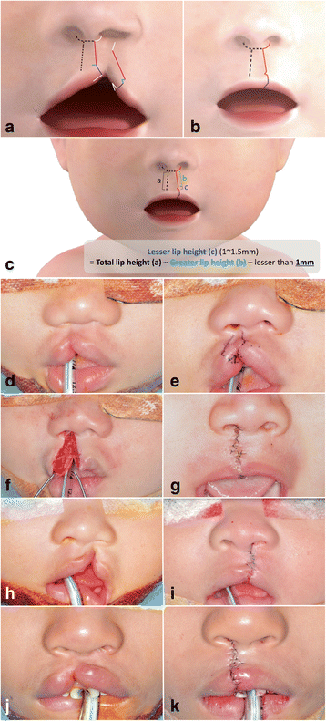 c flap cleft lip The design for repair according to the modified Modified Fisher method for unilateral
