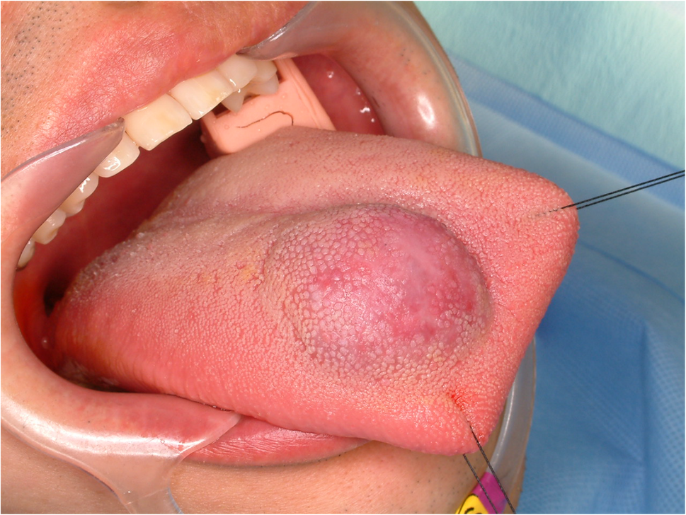 congenital melanotic macule of the tongue a) Lingua villosa nigra in a child after typhus; (b) Macules mlanotiques congnitales de la