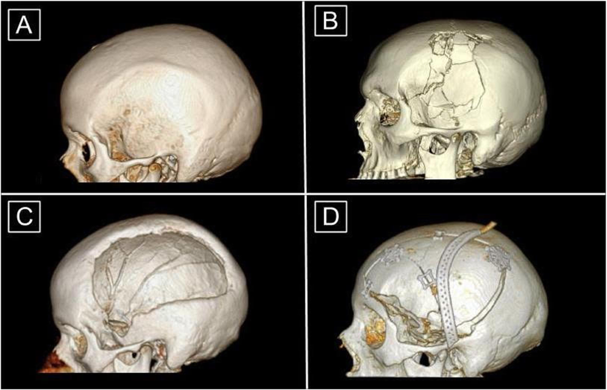 A retrospective descriptive study of cranioplasty failure rates and contributing factors in novel 3D printed calcium phosphate implants compared to traditional materials | 3D Printing in Medicine | Full Text