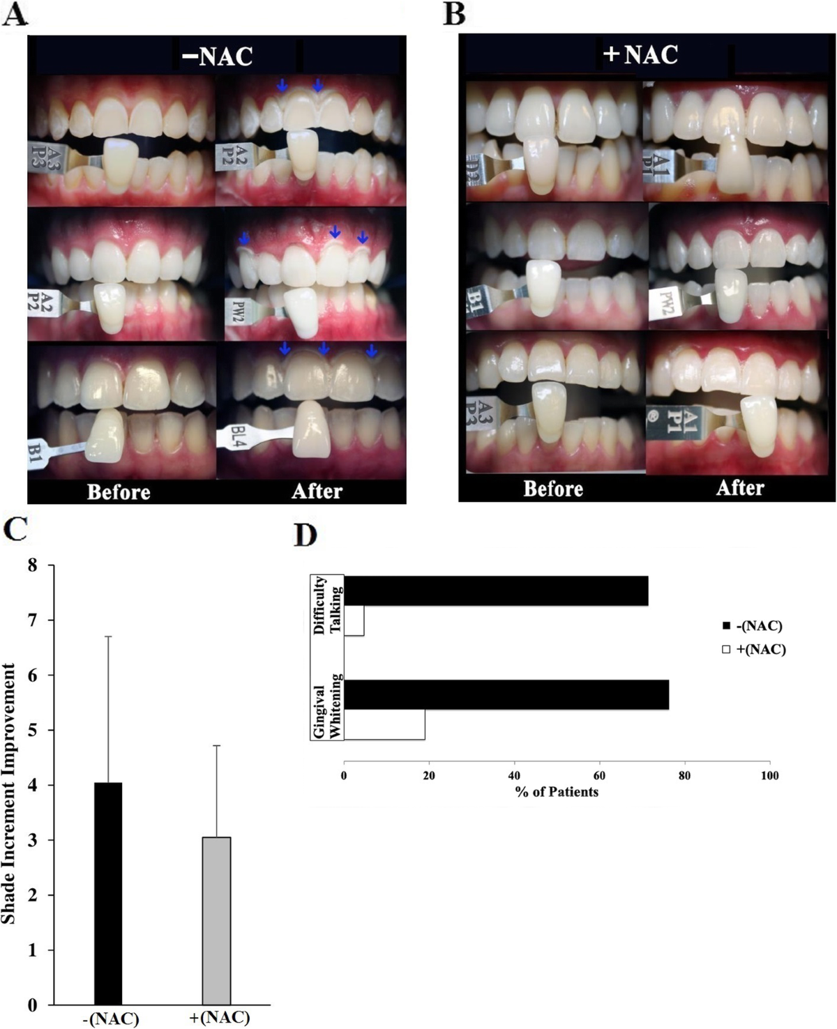 N-acetyl cysteine prevents pain and hypersensitivity of bleaching agents  without affecting their aesthetic appeal; evidence from in vitro to animal  studies and to human clinical trials | Translational Medicine  Communications