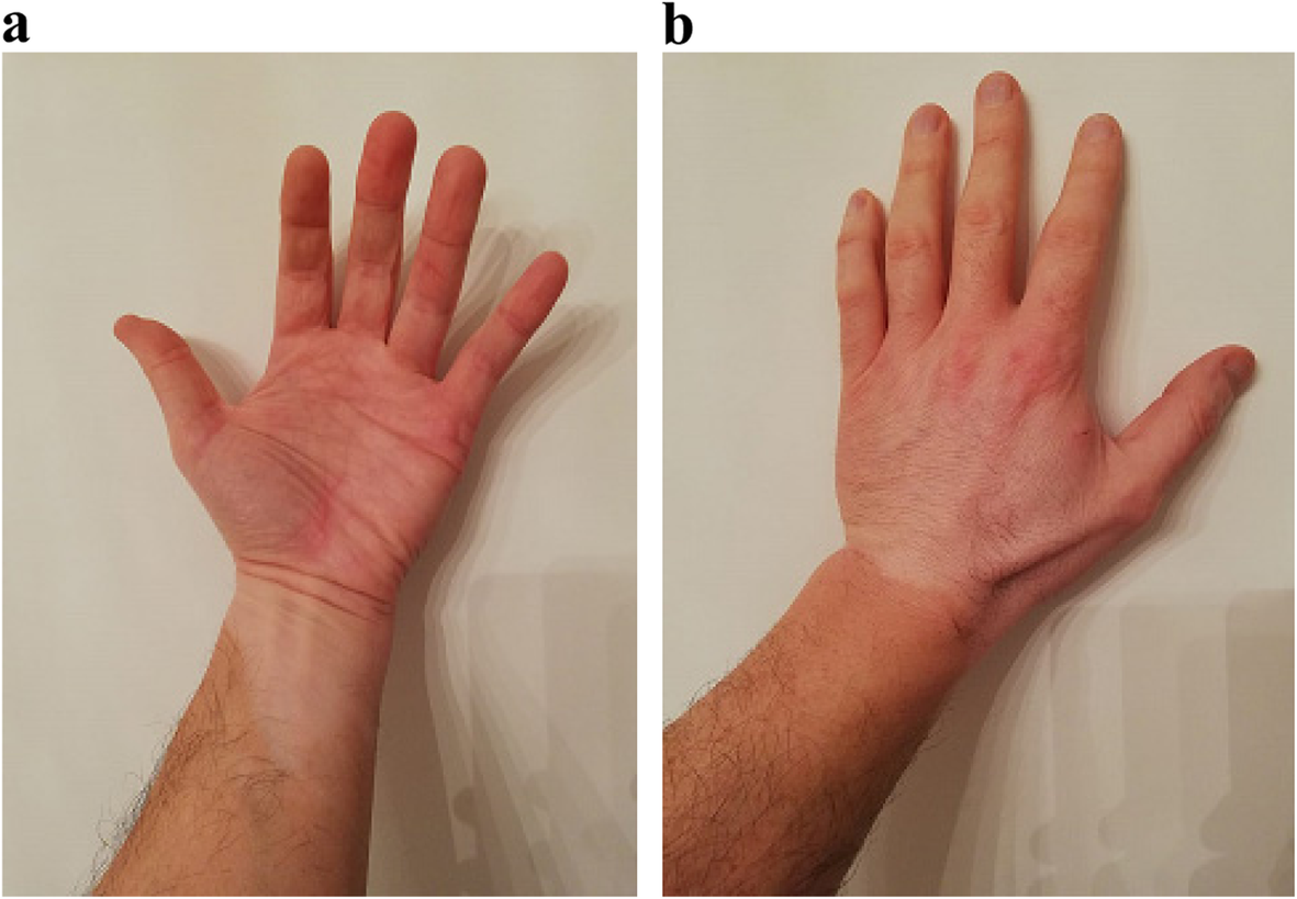 Vitiligo susceptibility at workplace and in daily life: the contribution of  oxidative stress gene polymorphisms | Biomedical Dermatology